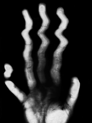 Torzított tenyér - Distorted palm